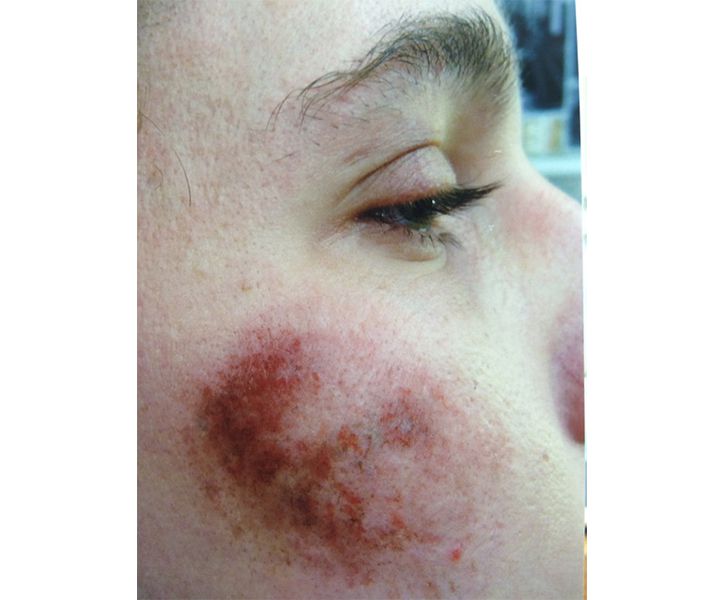 Bruise on Austin McKenzie as the young Cleve Jones, When We Rise