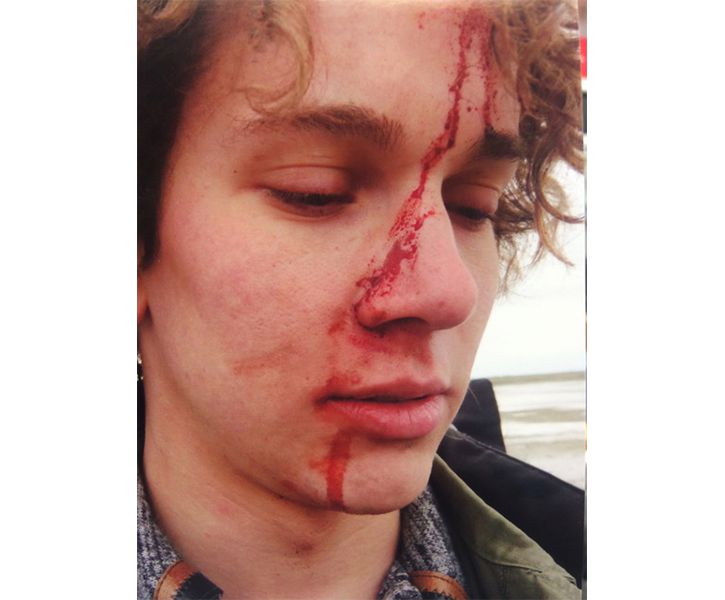 Bloodwork on Austin McKenzie as the young Cleve Jones, WHEN WE RISE