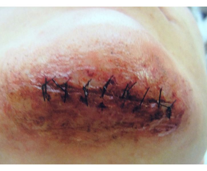 Hand sculpted Wound and stitches on Austin McKenzie as the young Cleve Jones, WHEN WE RISE